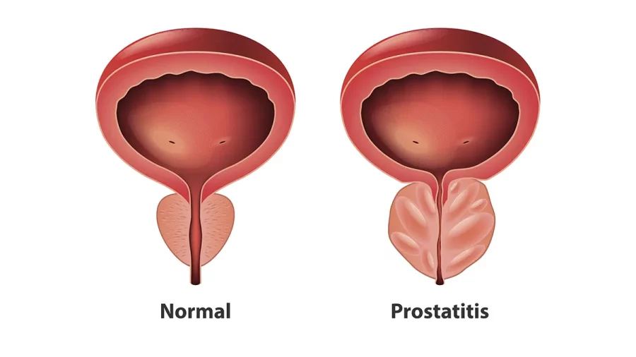 ¿Que problemas de salud puede ocasionar la próstata?